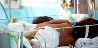 Sono morte le gemelline siamesi ricoverate a Bologna