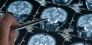 Sclerosi multipla, al Cardarelli il primo reparto ‘virtuale’ della Campania. Il direttore Longo: “Risposta d’eccellenza per garantire la sicurezza dei pazienti più fragili”