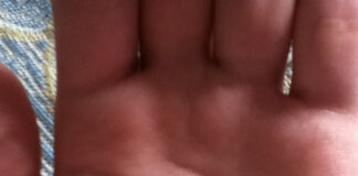 Tragedia sfiorata nel Napoletano, bimbo tenta di ingerire psicofarmaco caduto sul balcone, usato come droga