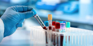 Covid-19: sono attualmente 37.704 i positivi in Campania. Provincia di Caserta: ecco i comuni più colpiti