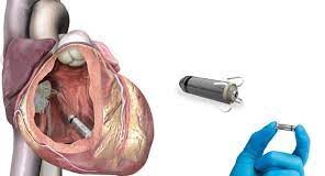 Castel Volturno: impiantato mini pacemaker a paziente di 104 anni