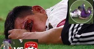 Grave infortunio per Lozano, operato nella notte per una ferita all’orbita oculare