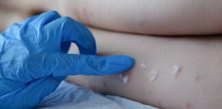 Boom delle patologie legate alle punture di zanzara: West Nile, vaiolo, usutu