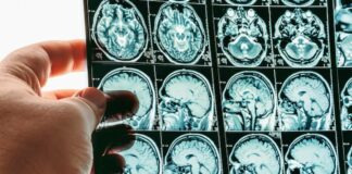 Alzheimer, autorizzato nuovo farmaco: svolta epocale, rallenta il declino cognitivo