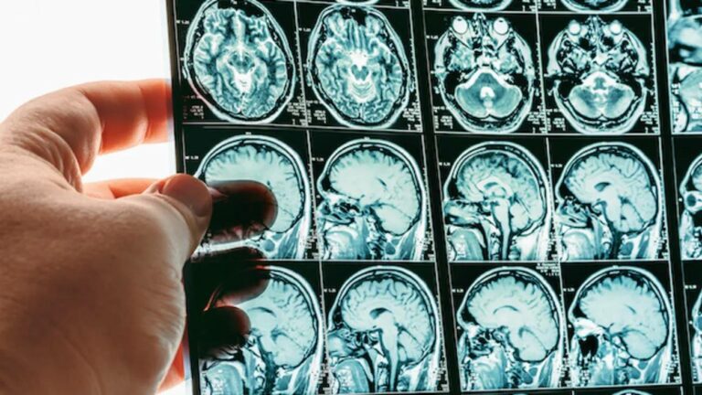 Alzheimer, autorizzato nuovo farmaco: svolta epocale, rallenta il declino cognitivo