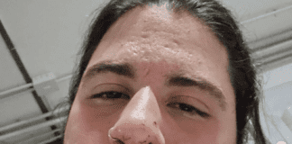 FOTO Napoli, artista di strada pestato a sangue dal titolare di un locale