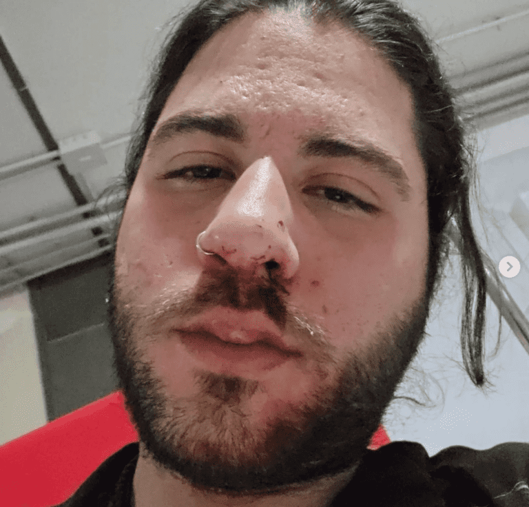 FOTO Napoli, artista di strada pestato a sangue dal titolare di un locale