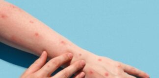 Vaiolo delle scimmie, in Svezia primo caso fuori dall’Africa