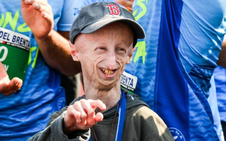 È morto a 28 anni Sammy Basso è morto, era il più longevo malato di progeria. Jovanotti: “Immenso dispiacere”